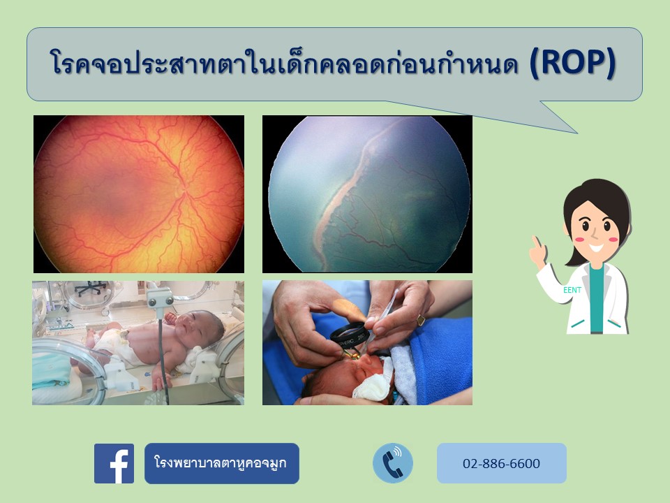 โรคจอประสาทตาในเด็กแรกเกิด (ROP)