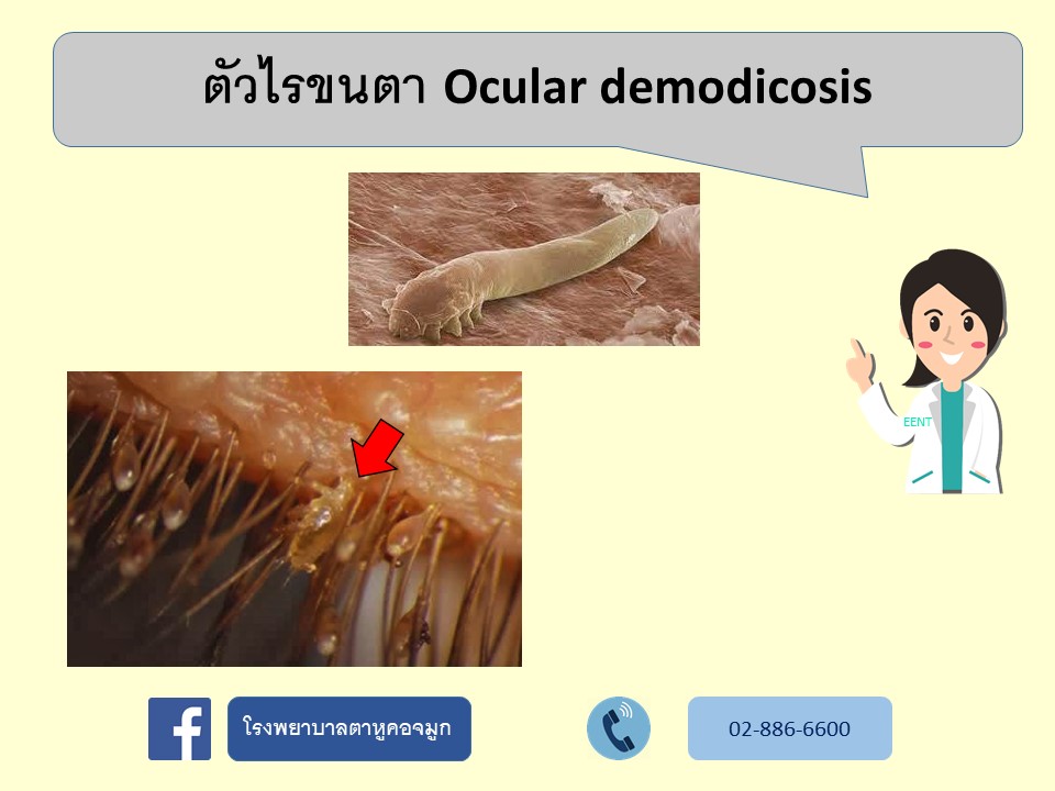 ตัวไรขนตา Ocular demodicosis