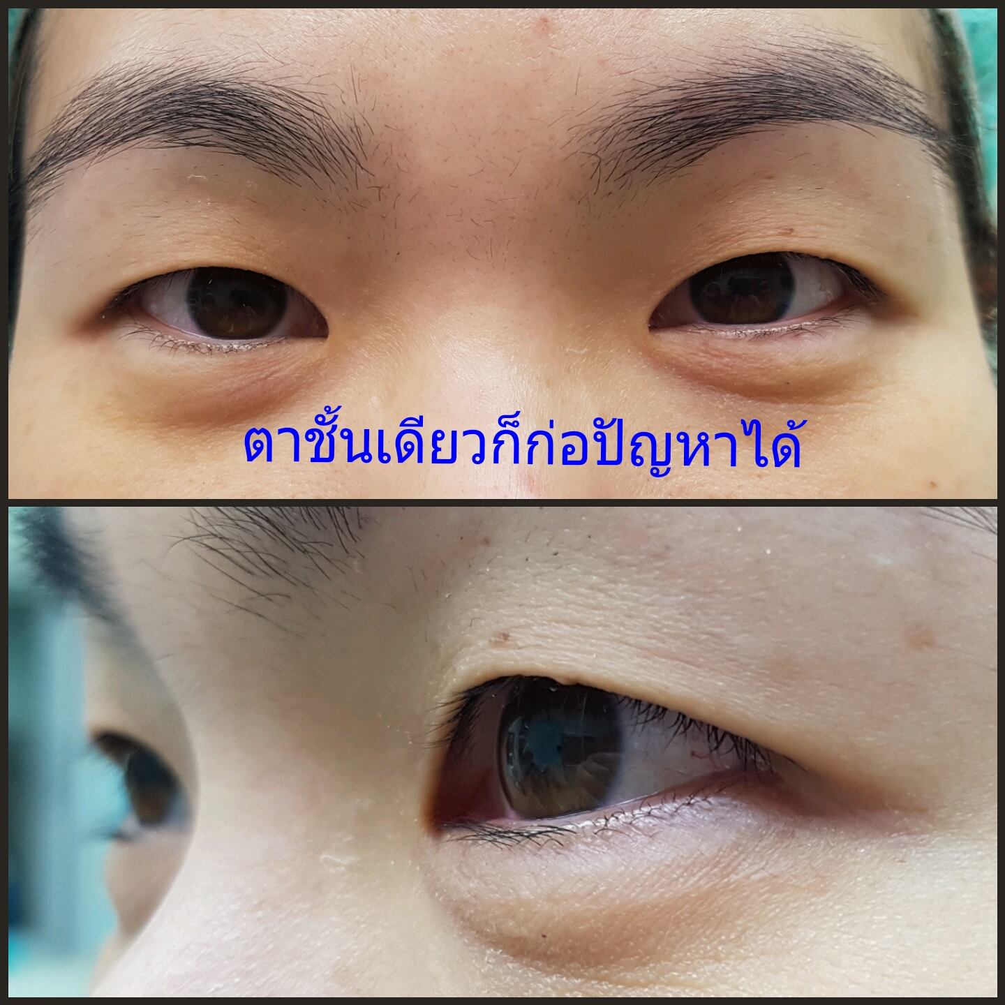 ตาชั้นเดียว (Single eyelid crease)