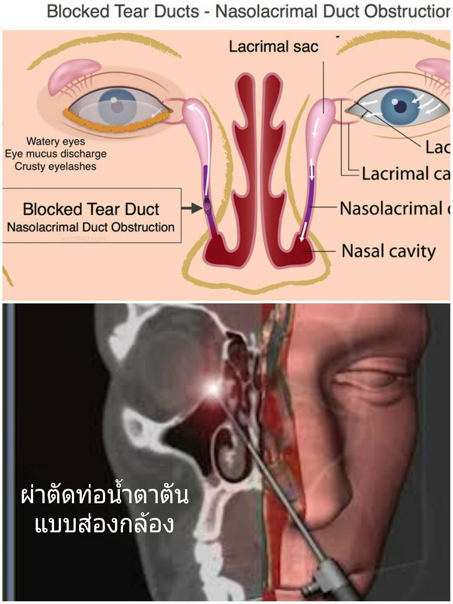 การแก้ไขภาวะท่อน้ำตาตันด้วยการผ่าตัด (Dacryocystorhinostomy, DCR)