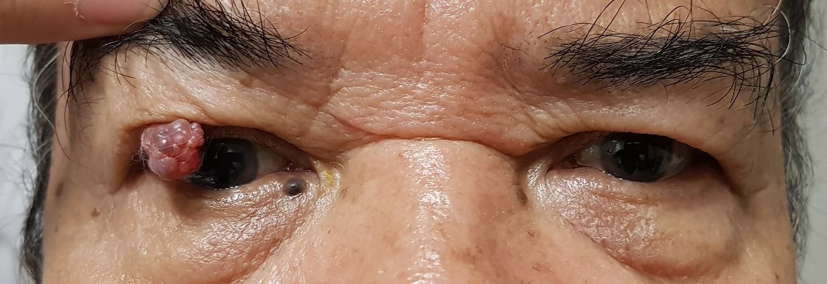 มะเร็งผิวหนังรอบดวงตา